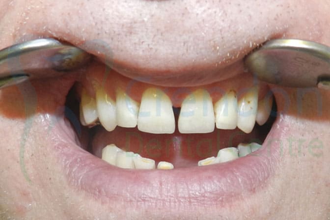 , Composite (tooth coloured) Fillings