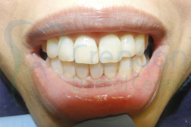 , Composite (tooth coloured) Fillings