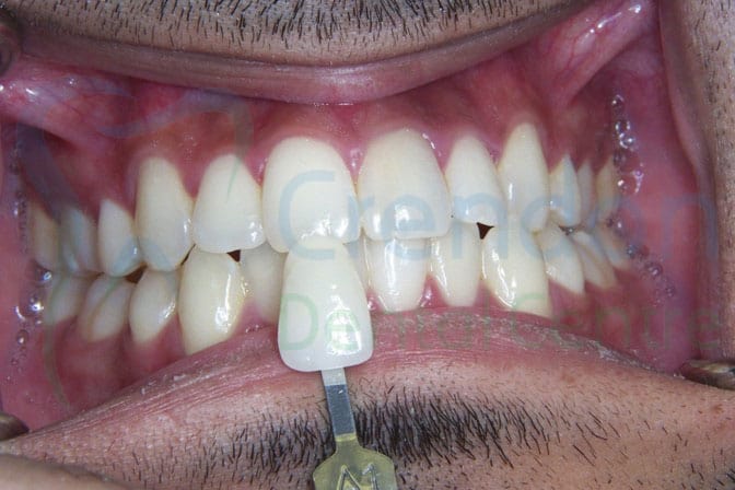, Teeth Whitening