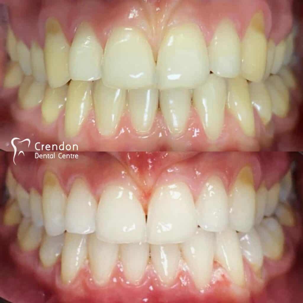 , Teeth Whitening – Enlighten