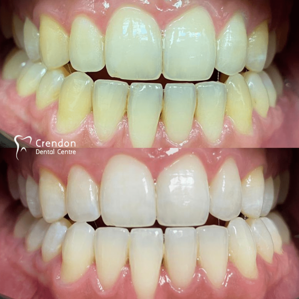 , Teeth Whitening – Enlighten