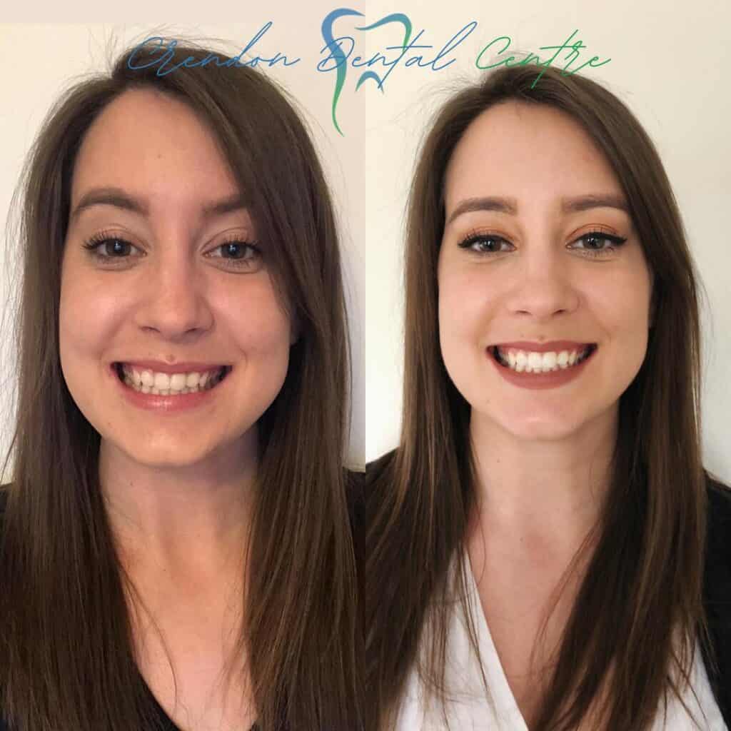 , Teeth Whitening – Enlighten