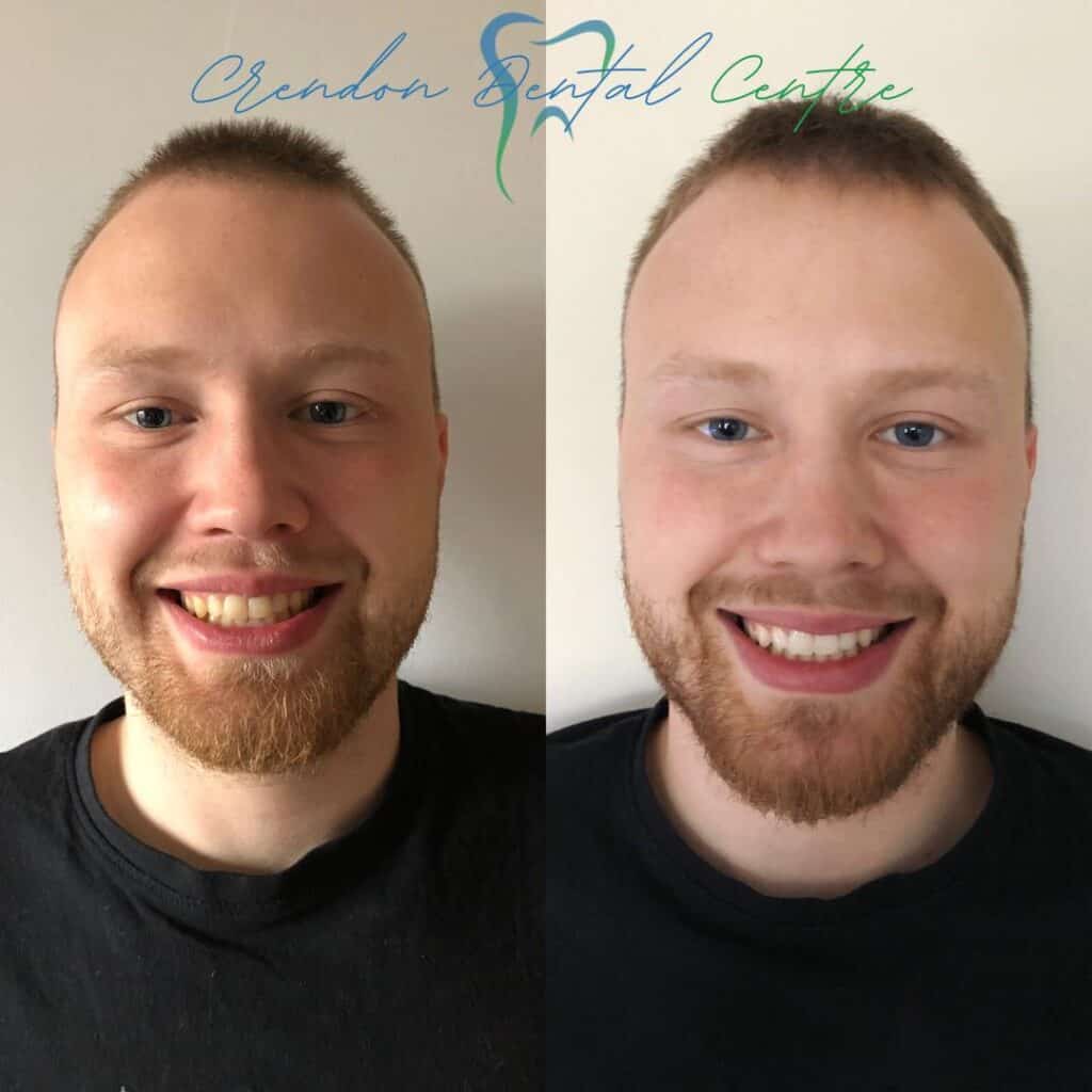 , Teeth Whitening – Enlighten