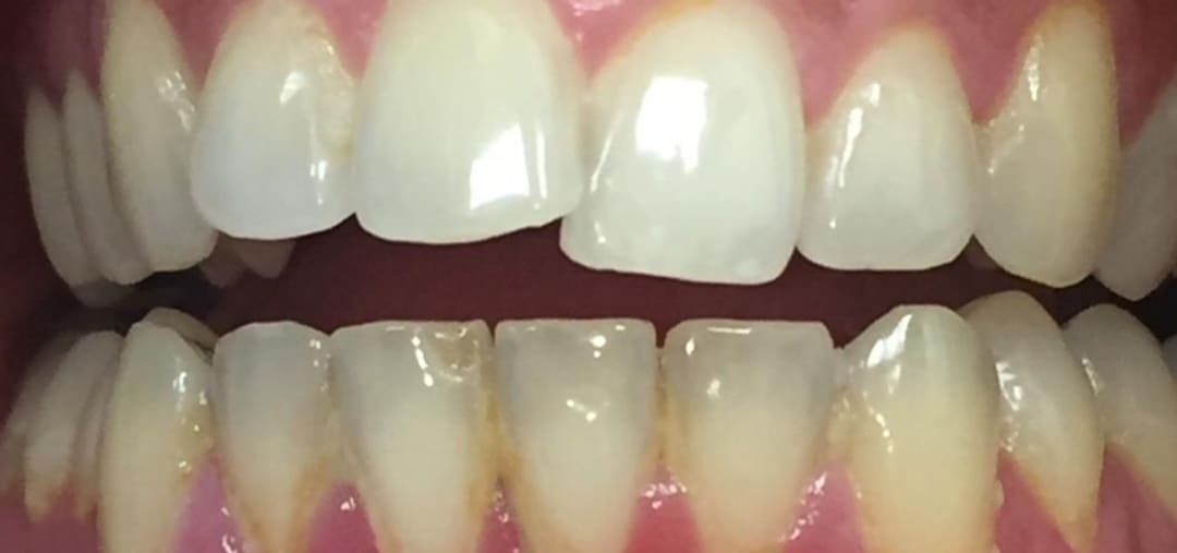 , Invisalign in High Wycombe