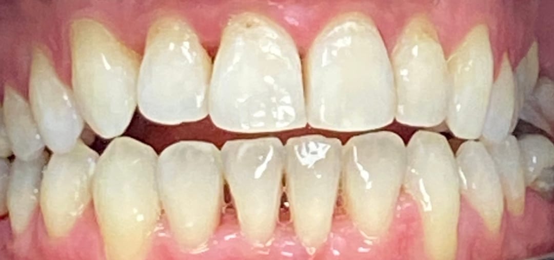 , Invisalign in High Wycombe