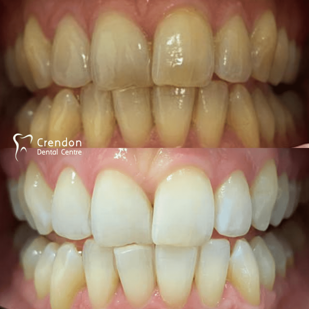 , Teeth Whitening – Enlighten