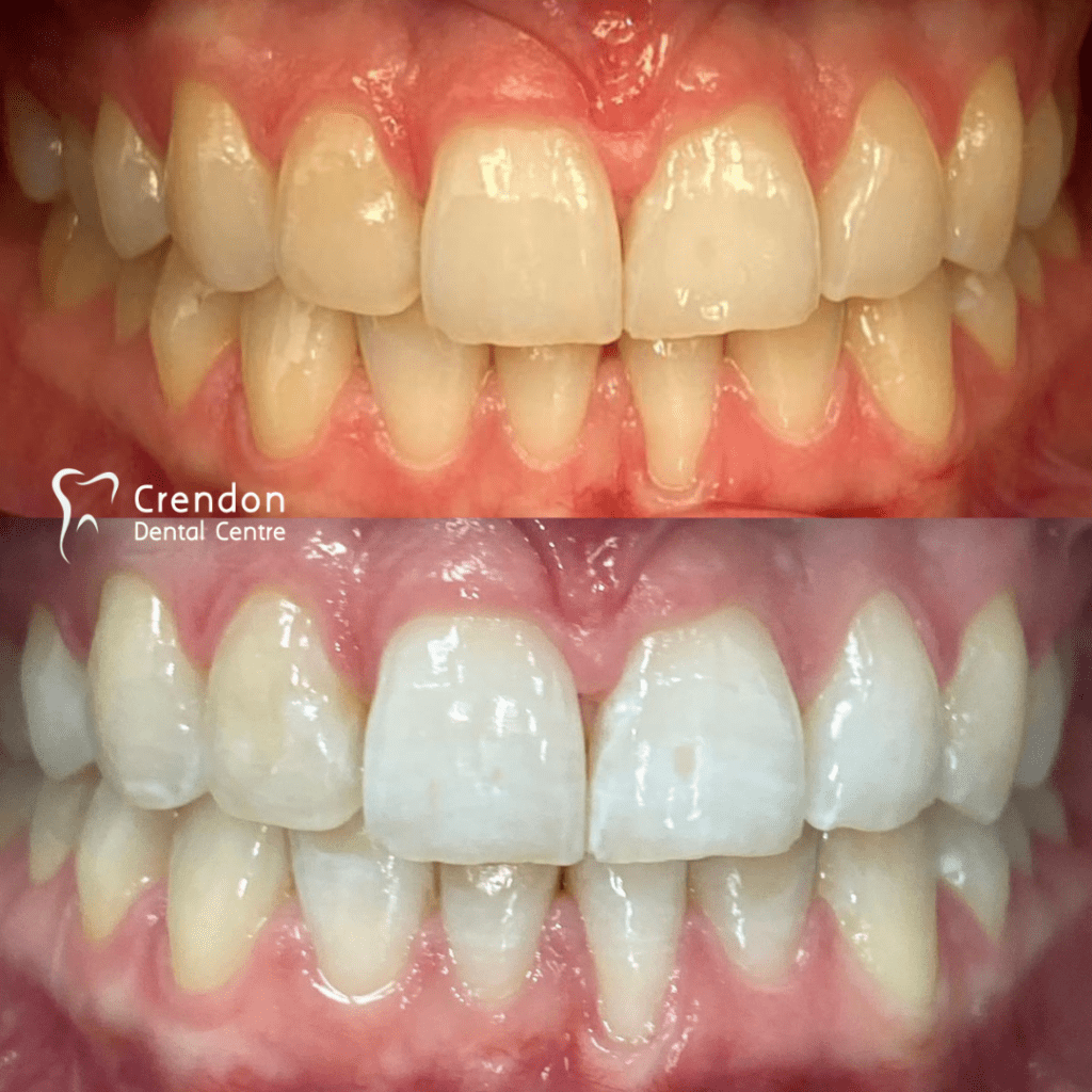 , Teeth Whitening – Enlighten