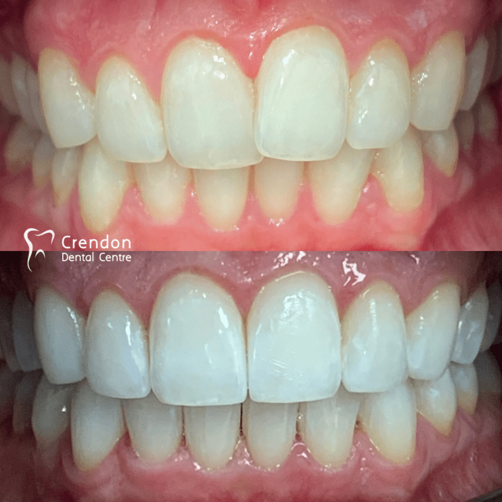 , Teeth Whitening – Enlighten