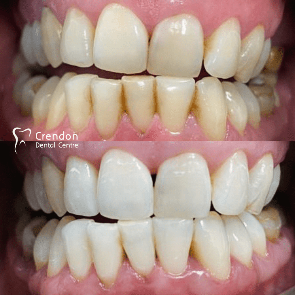 , Teeth Whitening – Enlighten