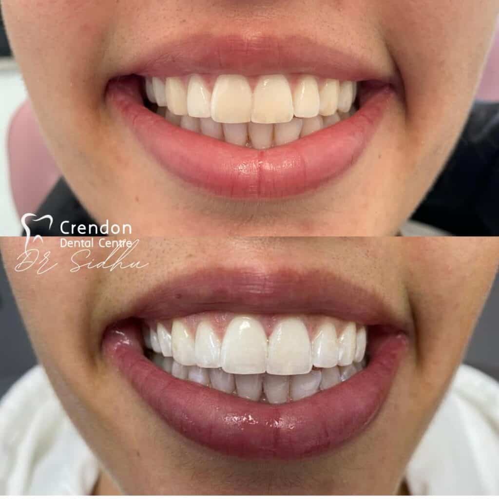 , Teeth Whitening – Enlighten