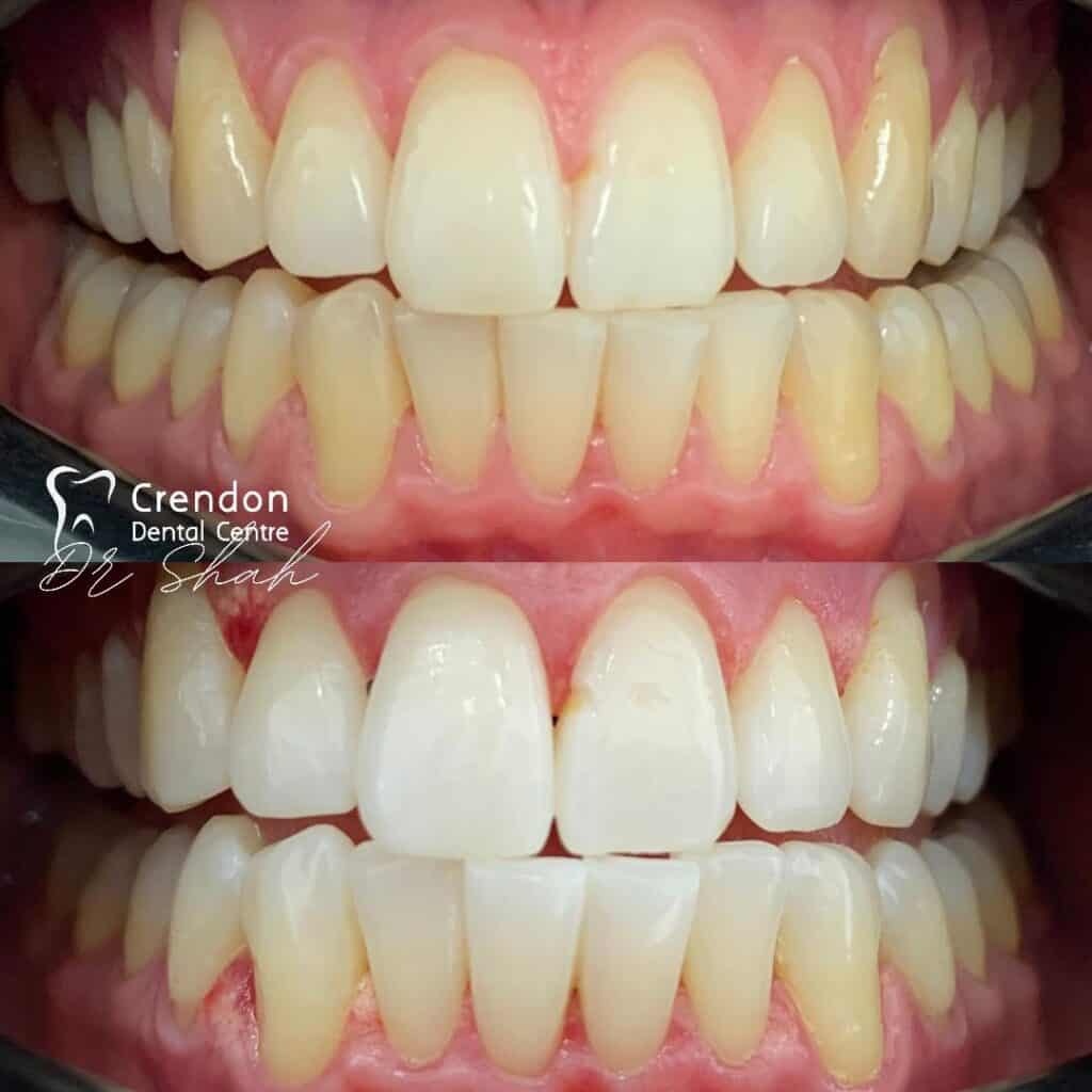 , Teeth Whitening – Enlighten