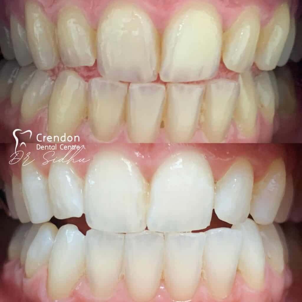 , Teeth Whitening – Enlighten