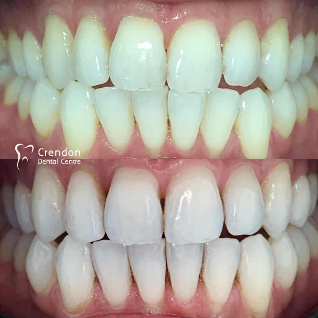 , Teeth Whitening – Enlighten