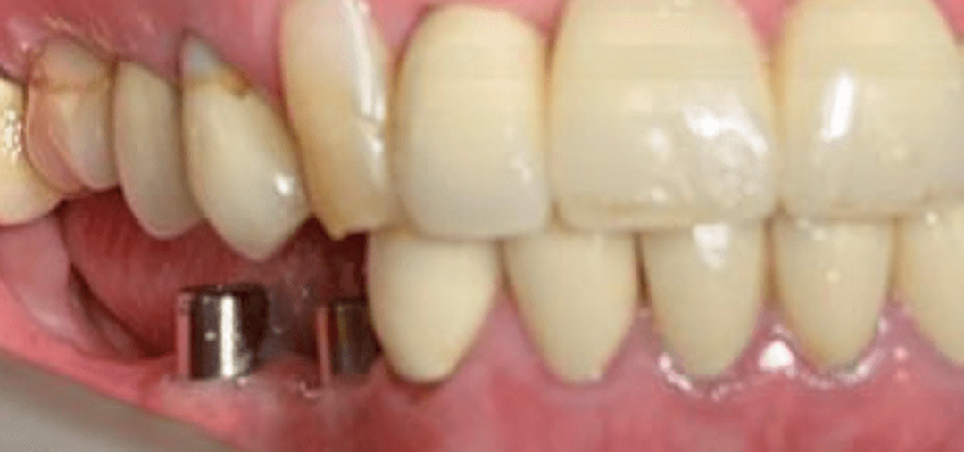 , Dental implants
