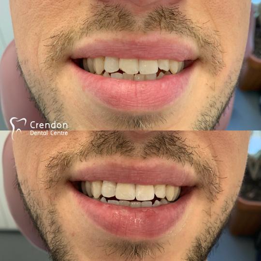 Composite Bonding - 2 , Composite Fillings