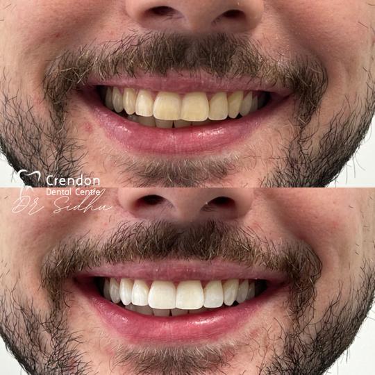 , Teeth Whitening – Enlighten