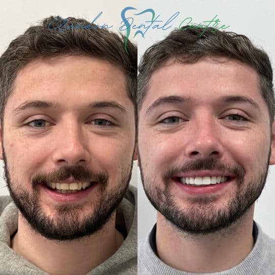 , Teeth Whitening – Enlighten