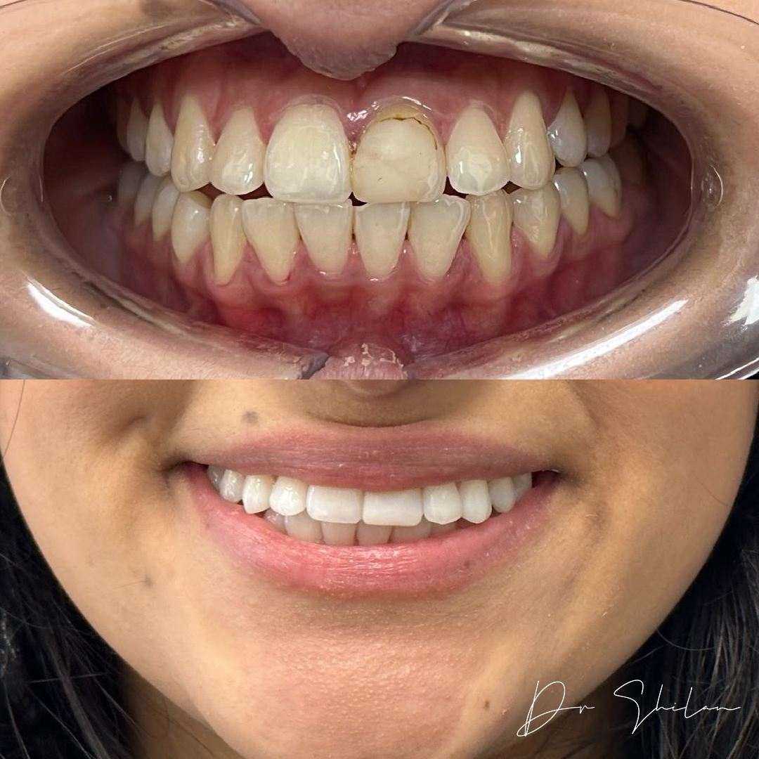 Composite Bonding Dentist High Dental Implants