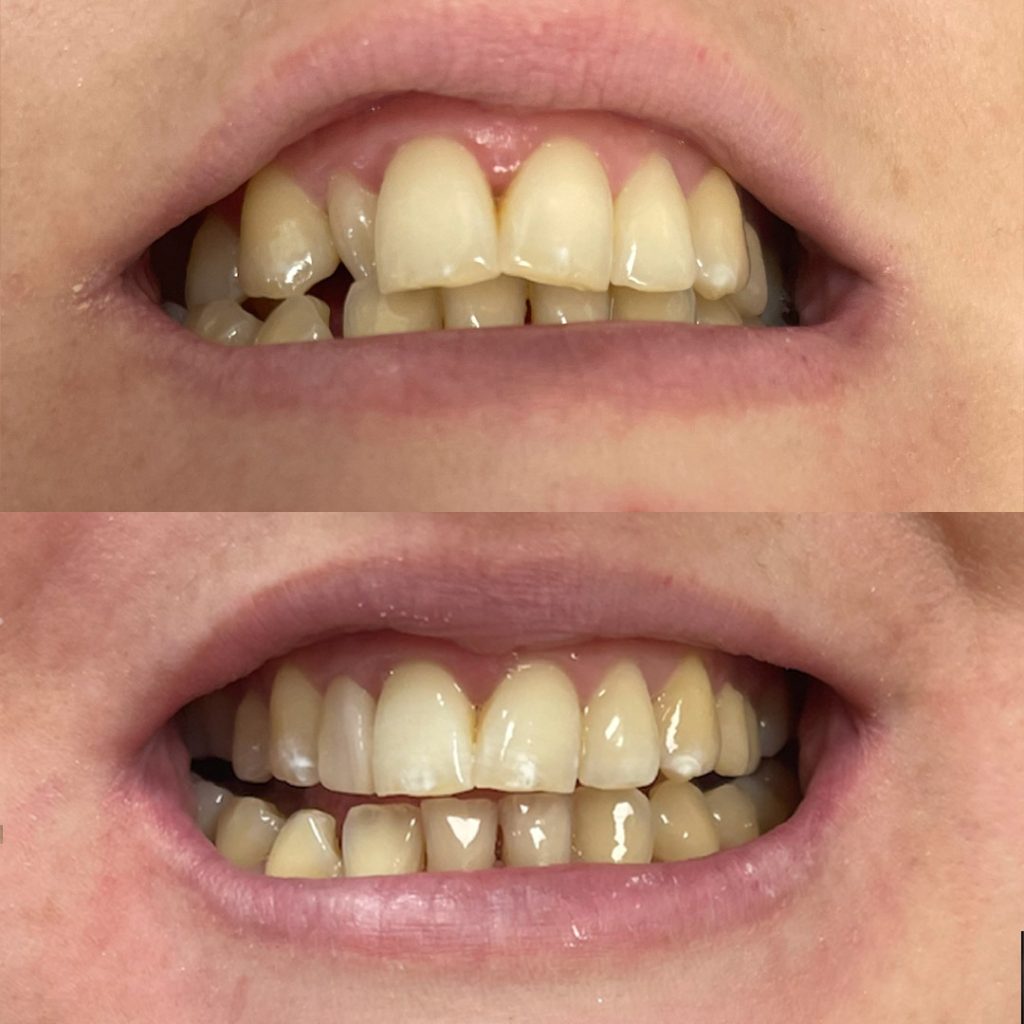 Composite Bonding Dentist High Dental Implants