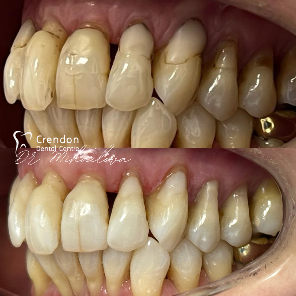 16138 B&A re-polishing&compbuildup - left , Composite Bonding