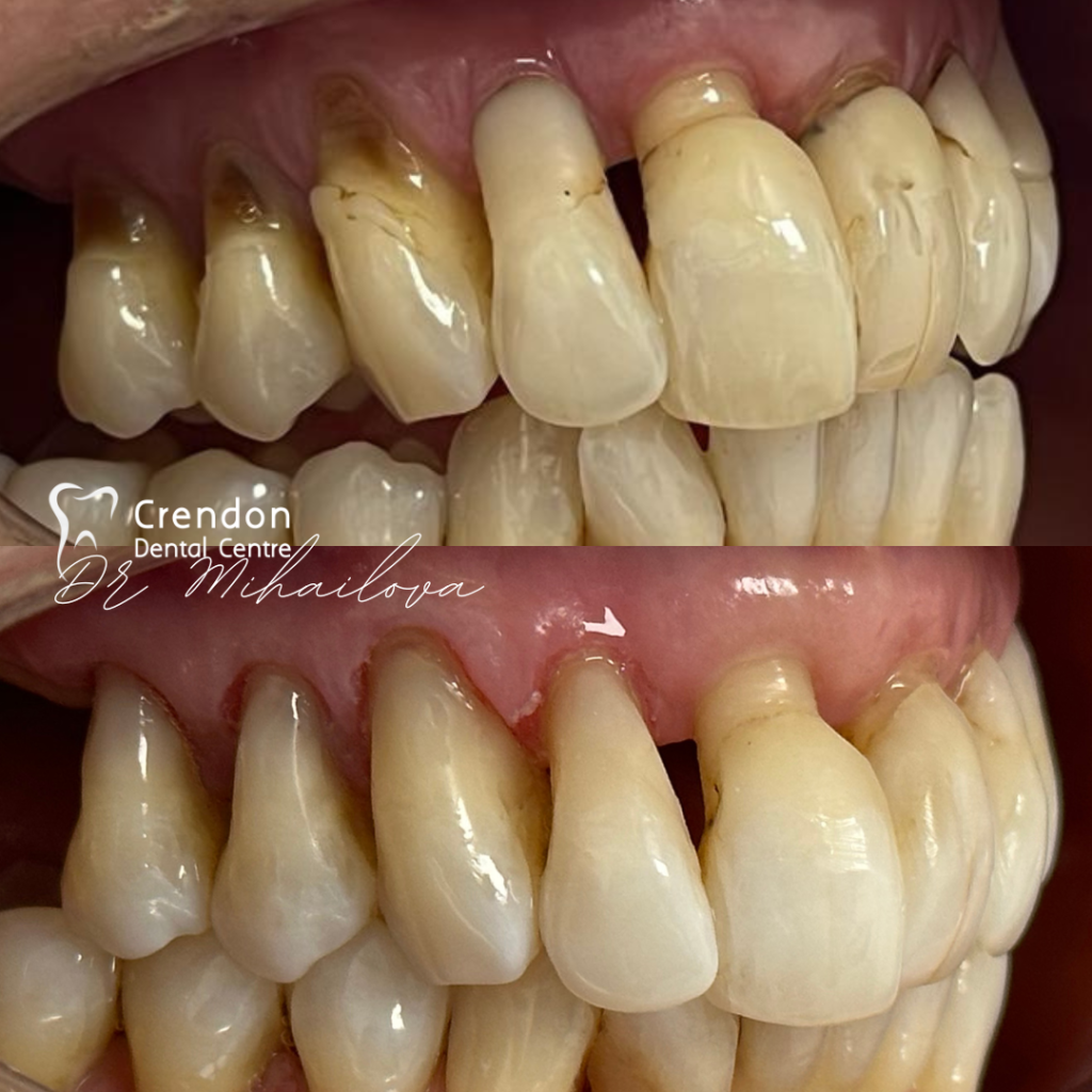 16138 B&A re-polishing&compbuildup - right , Composite Bonding