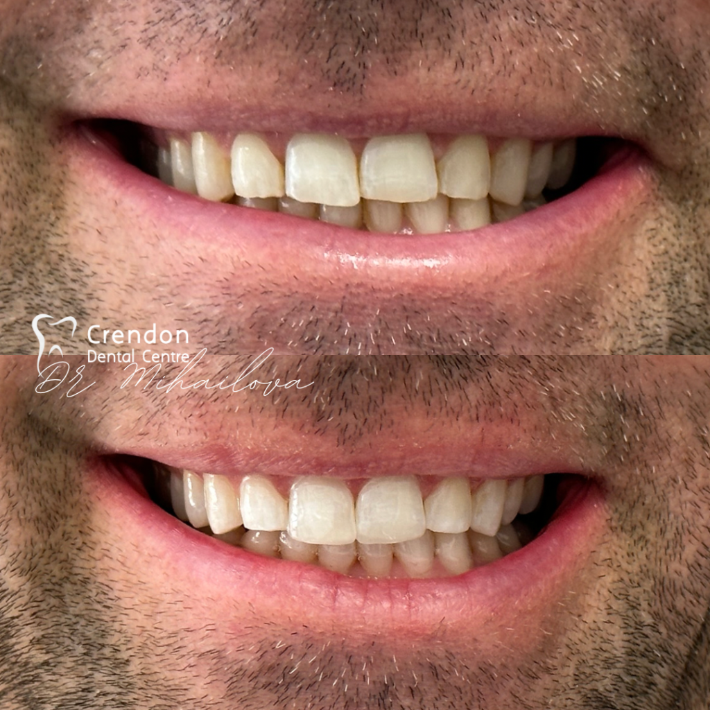 23163 B&A CompositeBonding FullConsent pic1 , Composite Bonding