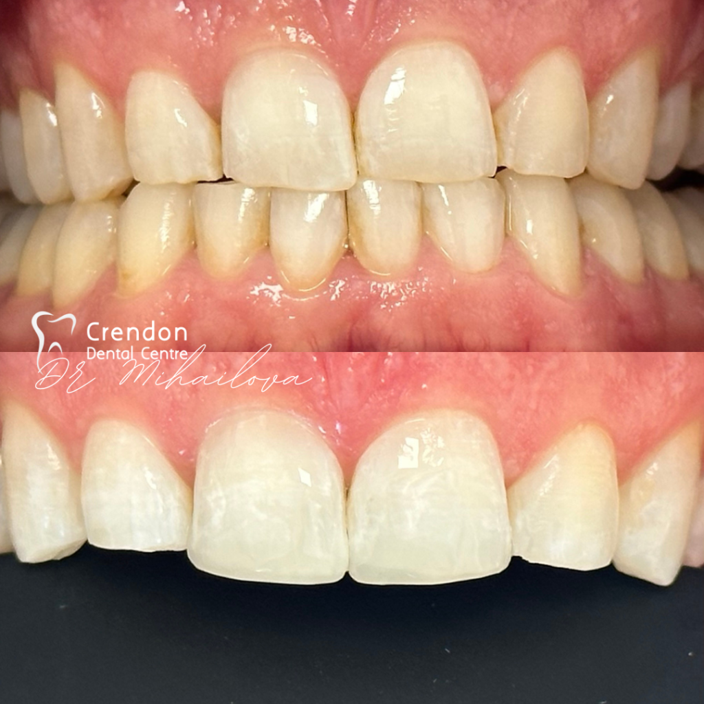 23163 B&A CompositeBonding FullConsent pic2 , Composite Bonding