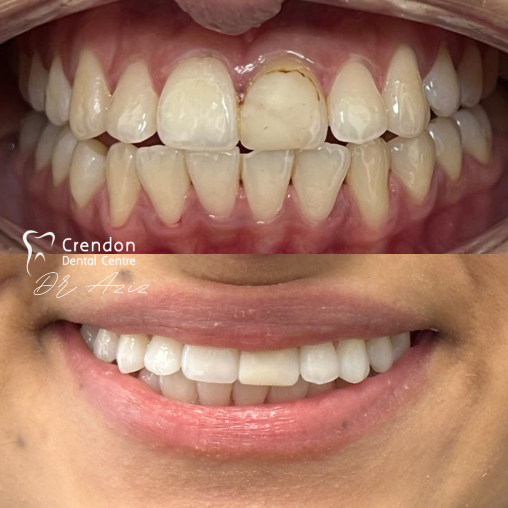 23710 B&A whitening+compveneer , Composite Bonding