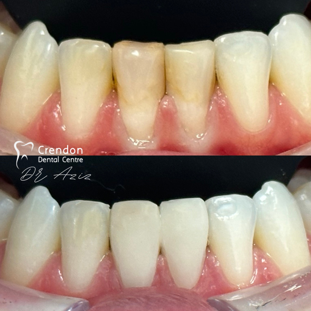 24113 Composite Bonding B&A consent given , Composite Bonding