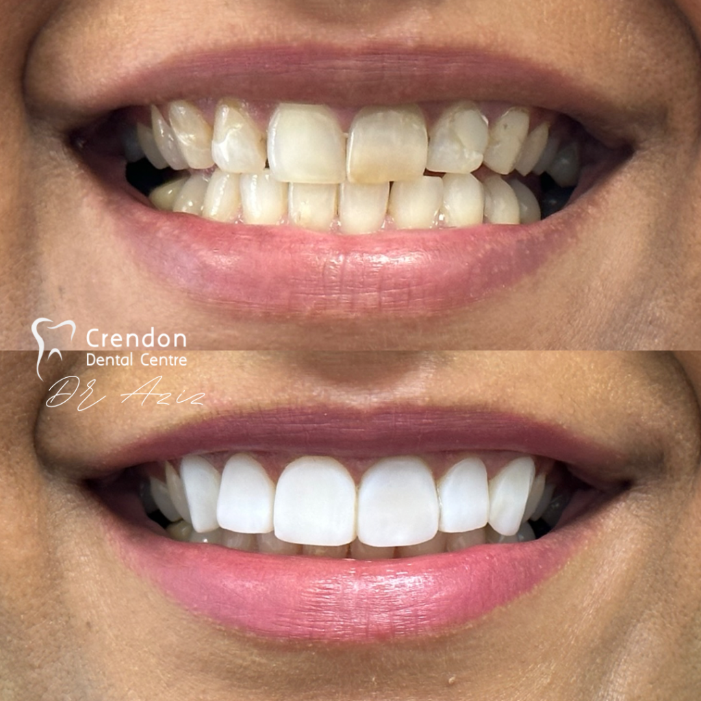 24266 B&A teethSmileConsent , Composite Bonding