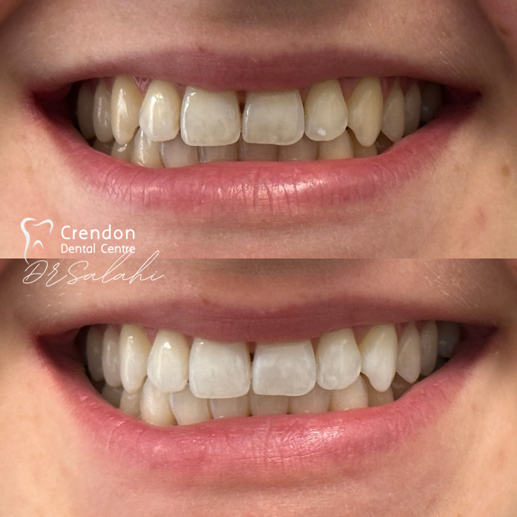 , Teeth Whitening – Enlighten