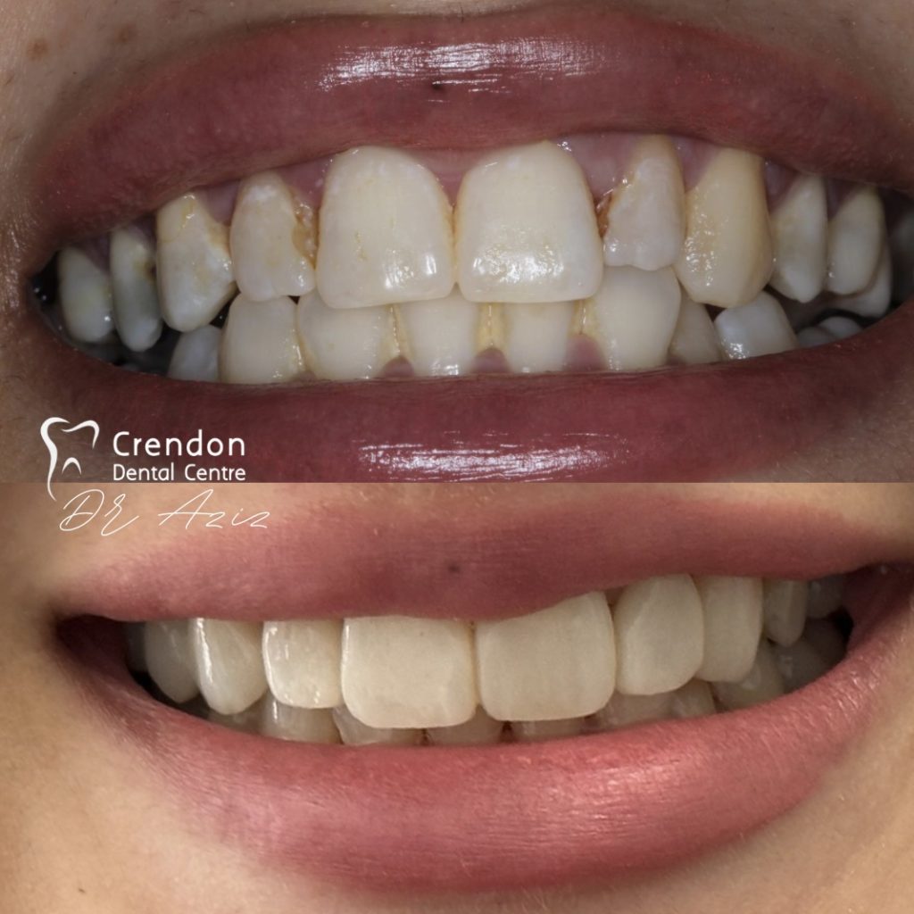 Composite bonding B&A Consent given , Composite Bonding