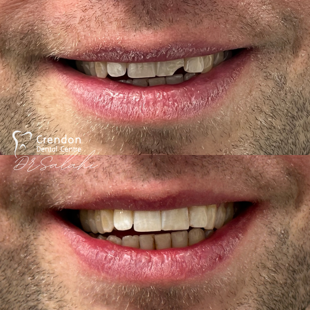 composite bonding B&A0 , Composite Bonding