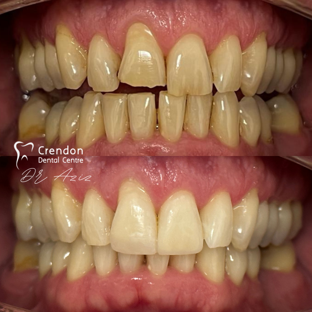 composite bonding B&A1 , Composite Bonding