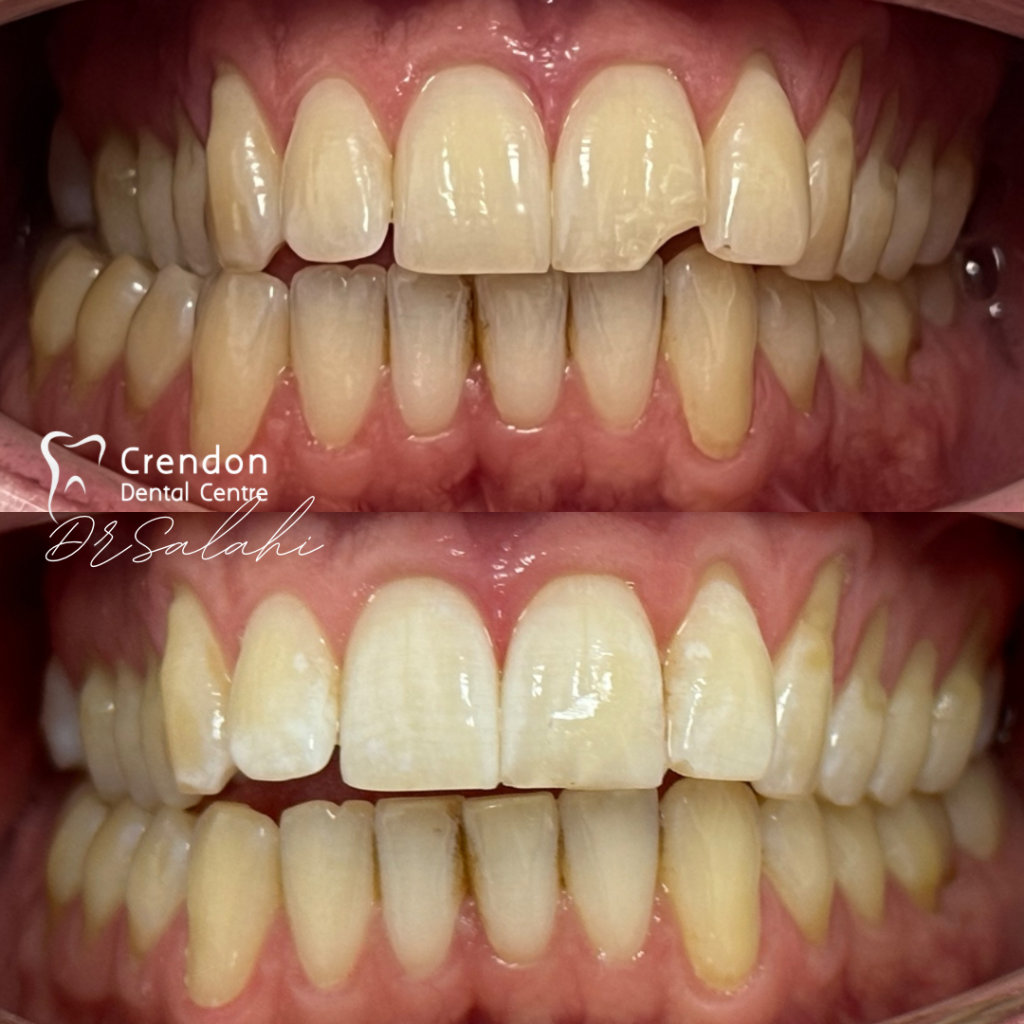 composite bonding B&A2 , Composite Bonding