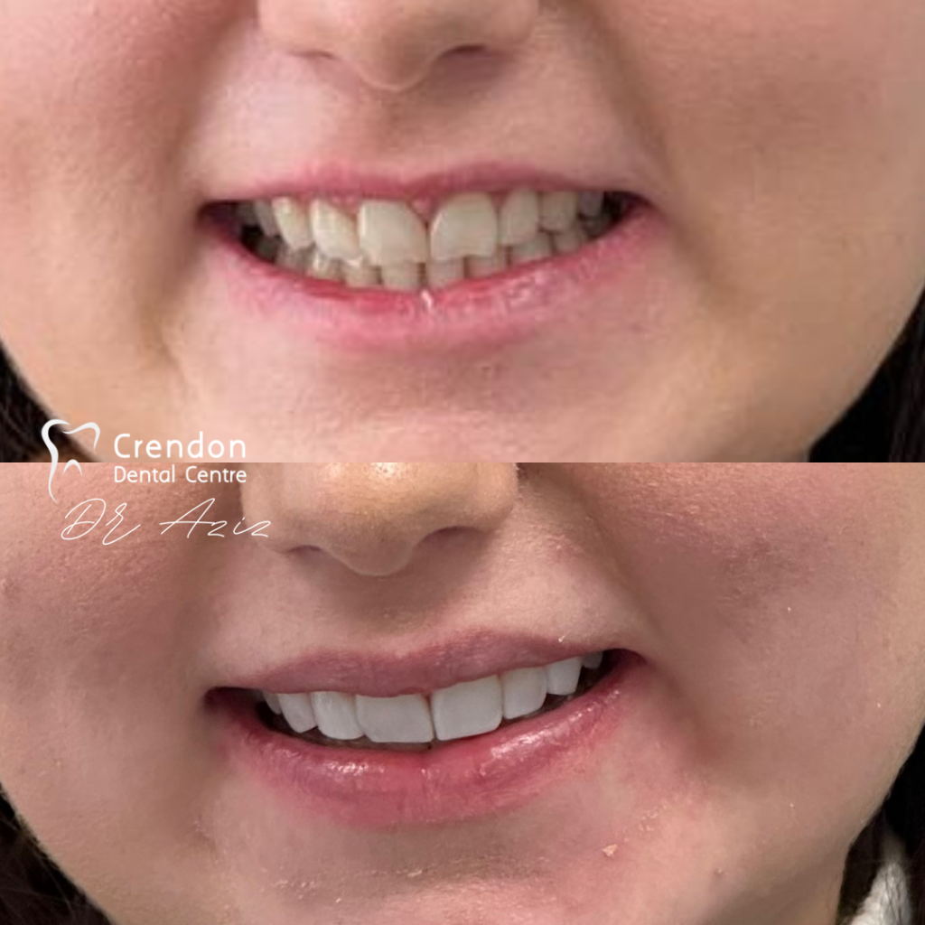 composite bonding B&A3 , Composite Bonding