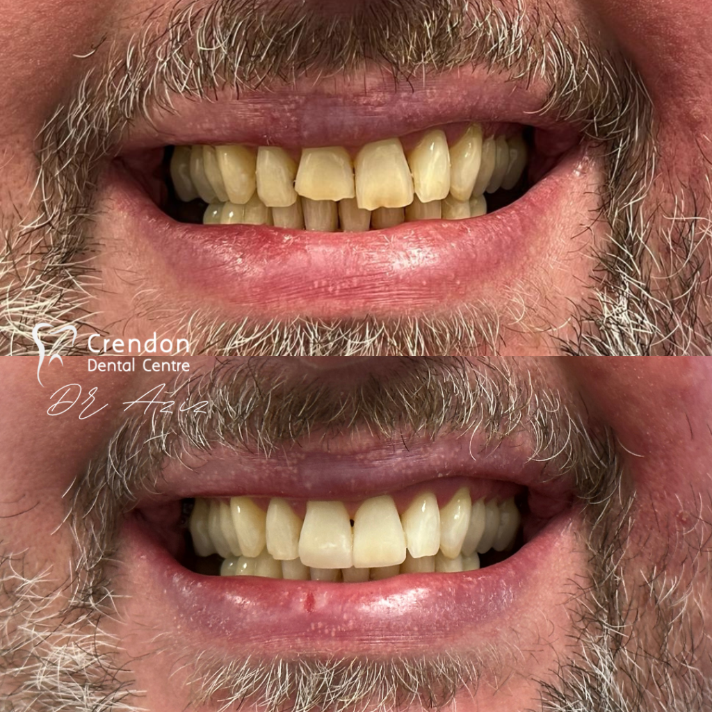 composite bonding B&A4 , Composite Bonding