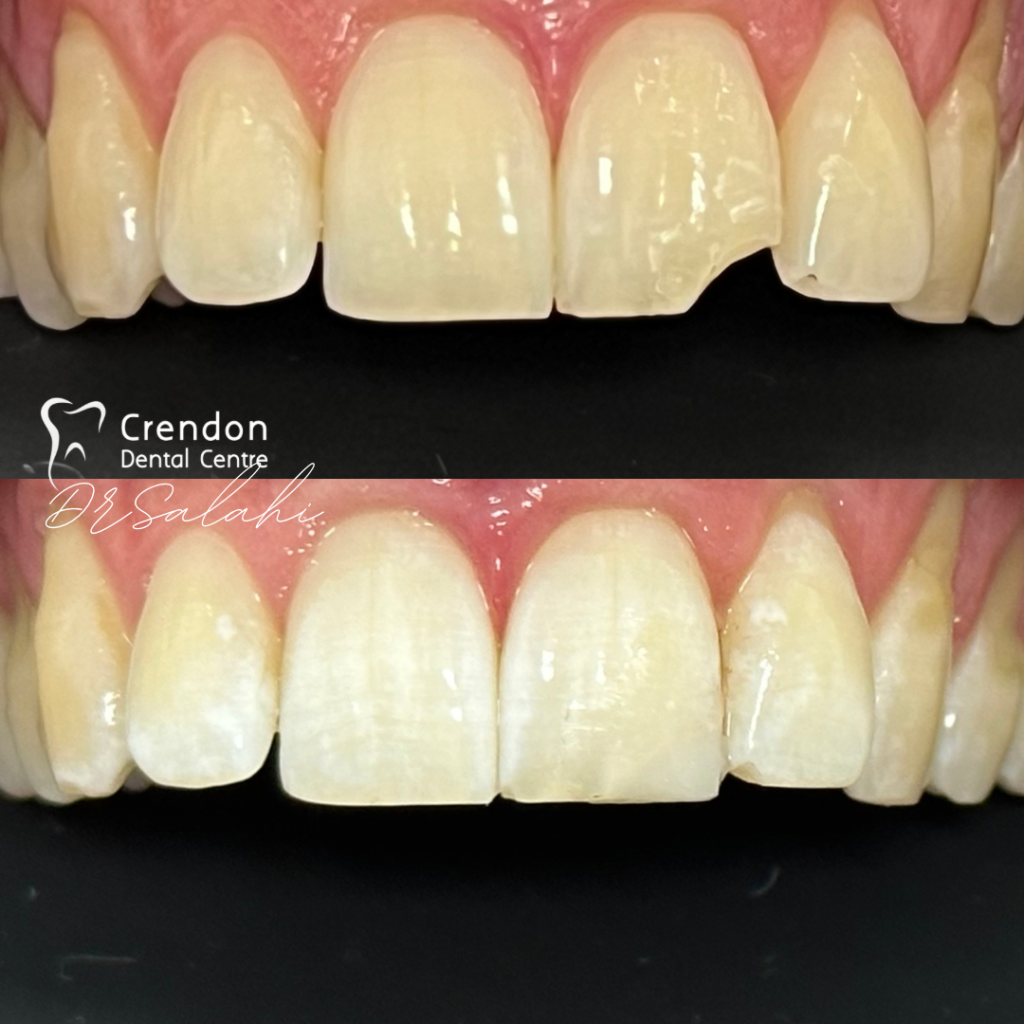composite bonding B&A5 , Composite Bonding