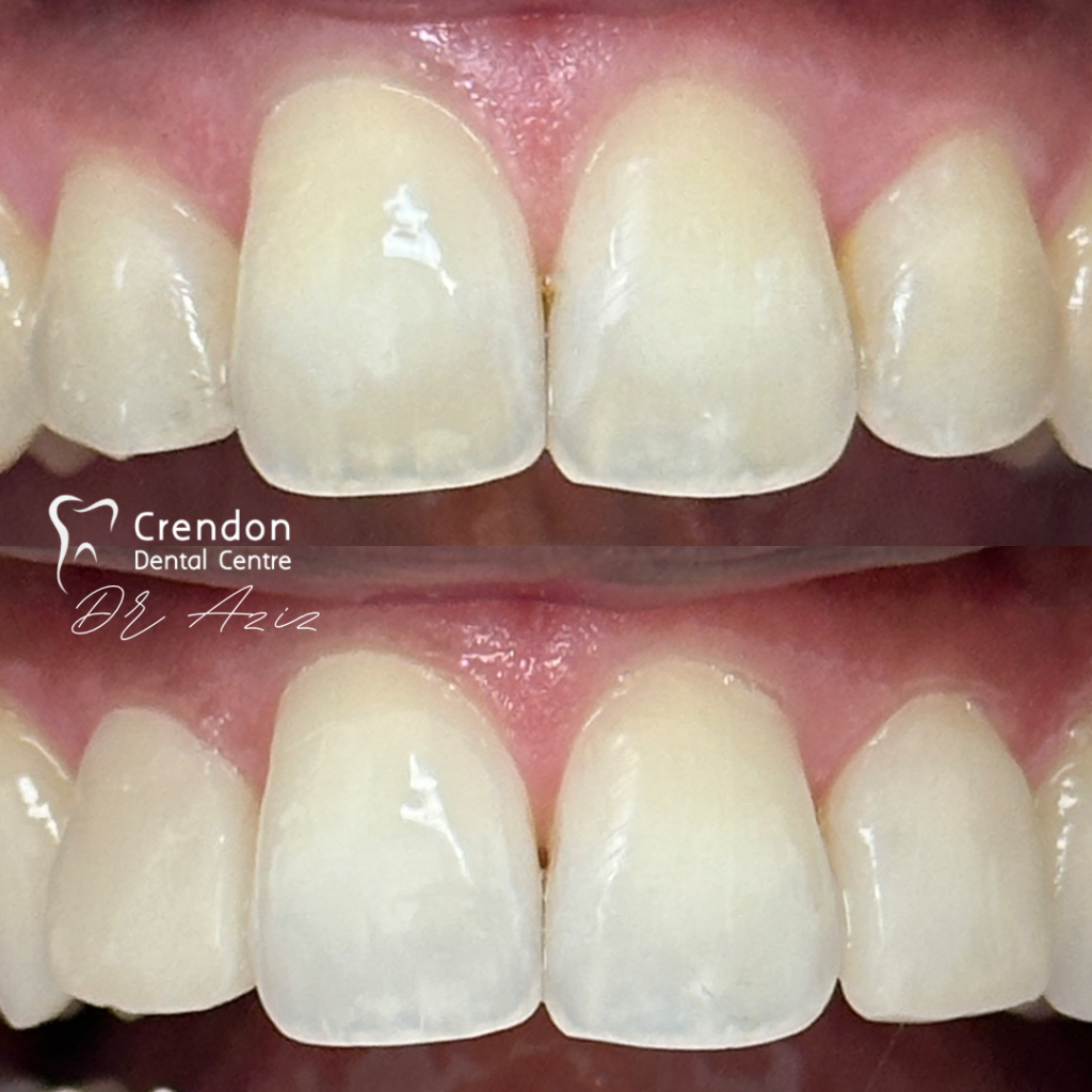 22837 B&A composite bonding - consented , Composite Bonding