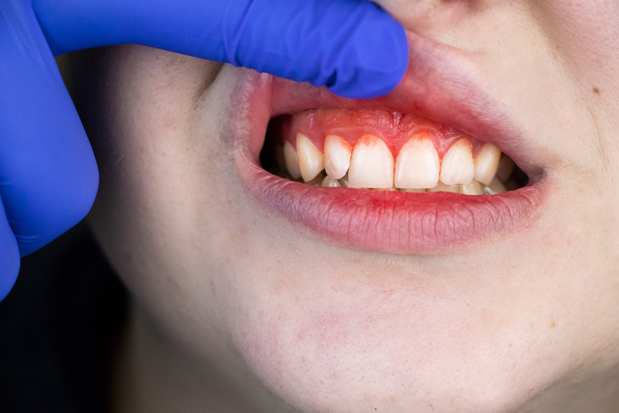 , Understanding Gum Disease